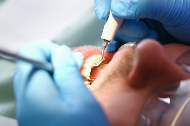 Best Emergency Root Canal Treatment in Dillon, SC